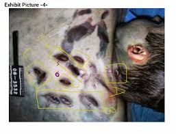 Arias initially denied having anything to do with travis' death, but when faced with evidence found at the crime scene, including a bloody palm print with her dna and a digital camera with photos of herself and travis taken on the day of the murder. Autopsy Miss Pajama Girl