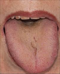 Black Coated Tongue In Integrative Medicine An Alarm Signal