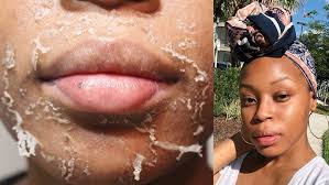 CHEMICAL PEEL EXPERIENCE