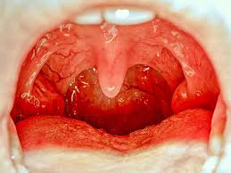 Image result for Uvulitis