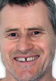 We cover all brace prices in the uk and offer our own exceptional brace solutions. Braces Before And Afters Total Orthodontics