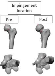Image result for Femoral Retroversion