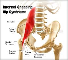 Snapping Hip Or Dancers Hip Treatment Exercise What Can Cause Your Hips To Snap