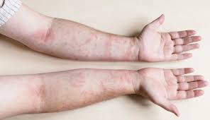 Image result for contact dermatitis