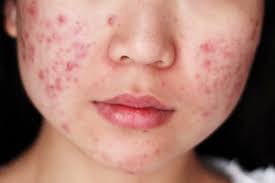 Tips Hilangkan Jerawat T9 Skincare