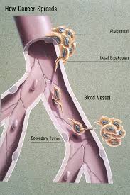 Metastasis Wikipedia Metastatic Cancer Mesothelioma Cancer