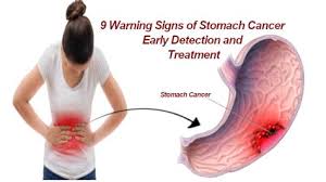 Signs and symptoms of colon cancer include: What S The First Sign Of Stomach Cancer The 12 Warning Signs Of Cancer Stock Vector Art More Stomach Cancer Also Known As Gastric Cancer Is A Cancer Which