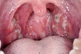 Infeccoes Estreptococicas Doencas Infecciosas Manuais Msd Edicao Para Profissionais