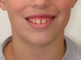 This treatment is also used to fix decayed or broken teeth below the gum line. Orthodontics And Facial Beauty Part Ii Gummy Smiles Austin Orthodontic Arts
