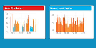 apples watch can detect an abnormal heart rhythm with 97