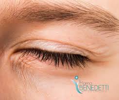 Image result for xantelasma