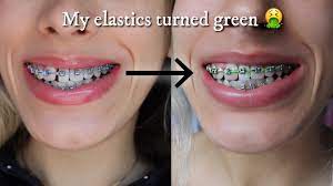 These are harder to stain, and if. My Braces Elastics Turned Green I Stained My Braces Oopsies Youtube