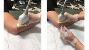 Image result for Elbow Joint Injection