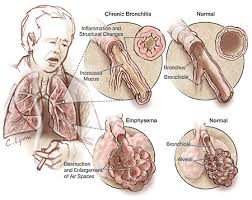 Fmes is directly approved by the florida board of respiratory care. Chronic Obstructive Pulmonary Disorder Copd Case Study Nursing Crib