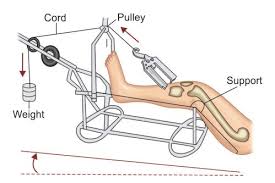Definition a longitudinal skin traction applied to extremity in one direction with a single pulley, and keeping the leg in extended position without hip flexion. Jaypeedigital Ebook Reader