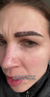 Day 4 Healing Process Microshading