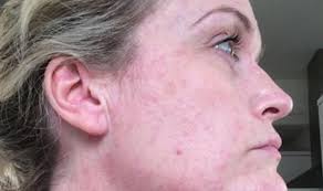 Hives treatment aims to alleviate symptoms. Jen Ferguson Credits Monthly Jabs And Treatment For Curing Her Hives Express Co Uk