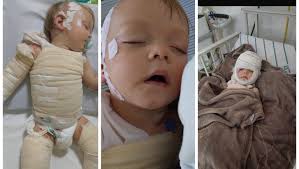 Fundraiser by Amabia Marques : Ajuda para tratamento de queimadura Help  with burn treatment