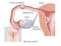 A false negative result usually occurs because the pregnancy test was taken too early to detect the pregnancy. Implantation Bleeding When Does It Occur How Long Does It Last Babycenter