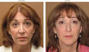 Before and after treatment photos from advanced dermatology & skin cancer center in northwest arkansas. Sculptra Before And After Pictures Dr Turowski Plastic Surgery Chicago