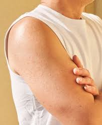 Image result for Keratosis pilaris