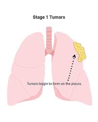 The 4 Mesothelioma Stages Prognosis Symptoms By Stage