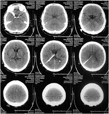 Brain Ct Scans Showing Normal Ventricles After Ventriculoperitoneal Download Scientific Diagram