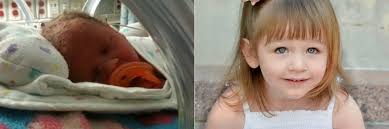 Side-By-Side Preemie Photos Show How Far These Little Fighters Have Come