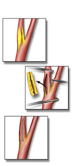 Endarterectomy Wikipedia