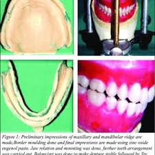 We did not find results for: The Denture Air Dried And Chairside Attachment Processing Material Download Scientific Diagram