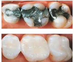 Do teeth fillings hurt metal. Aesthetic Fillings Cosmetic Dentistry