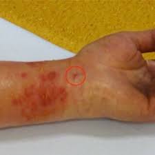 Image result for spinne biss haut reaktion