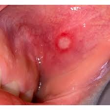 Image result for Labial mucosa
