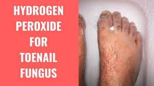 Hydrogen Peroxide Effective For Treating Toenail Fungus Youtube