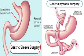 Both gastric bypass and gastric sleeve bariatric surgeries are common to help patients lose weight. Gastric Sleeve Reviews Surgery Complications Recovery Time And Diet