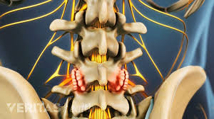 As we age, the slippery tissue called cartilage that covers the ends of the bones within joints breaks. What Are Lumbar Osteophytes Bone Spurs