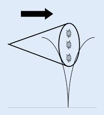 S3 Leitlinie Sinus Pilonidalis 2 Revidierte Fassung 2020 Springerlink