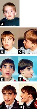 Mowat Wilson Syndrome Orphanet Journal Of Rare Diseases Full Text