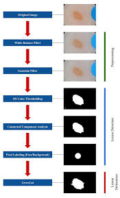 When a doctor performs a skin check, they look. Fully Automated Growcut Based Segmentation Of Melanoma In Dermoscopic Images Journal Of Young Investigators