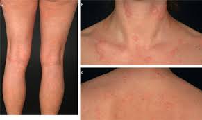 Ein virus viren beherrschen die medizinische berichterstattung der medien. Exantheme Jenseits Von Kinderkrankheiten Springerlink