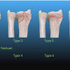 Near the wrist at the farthest (distal) end of the bone, in the middle of the forearm or near the after removal of the cast, you will start physical therapy with specific exercises to regain full range of motion of your elbow and wrist and rotation of the forearm. Https Encrypted Tbn0 Gstatic Com Images Q Tbn And9gcrhipmeqzyo7t F Pnimkghxih5idkkozpqkdpxvwzsg07ktort Usqp Cau