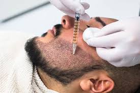 La greffe de barbe est le processus par lequel des follicules pileux sont prélevés dans des zones appropriées et transplantés dans la zone des poils du visage où une perte de barbe faible ou complète est visible. Greffe De Barbe En Tunisie Tunisie Esthetique Dossier Complet