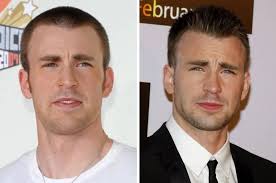 Did Chris Evans Get a Hair Transplant? Full Analysis & Photos