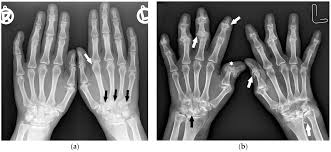 Image result for XRay Changes in Rheumatic Conditions