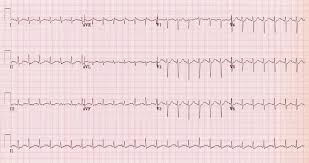 In the acute setting can cause arrhythmias, cardiac failure, cardiogenic shock and death. Pediatric Viral Myocarditis Em Sim Cases