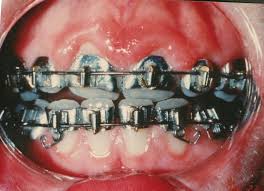 Fully Banded Braces 1970s Full Band Orthodontics Seventies Orthodontics Orthodontics Braces Orthodontic Appliances
