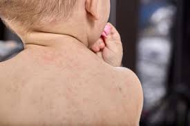 Image result for sweat rash on back baby