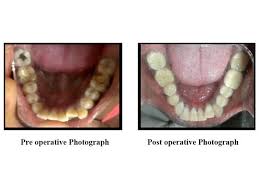 In some cases, a crown may not be necessary. Importance Of Crown On Root Canal Treated Tooth