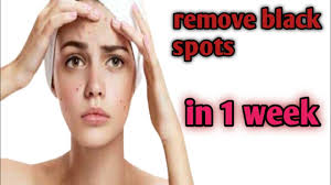 To remove dark spots, the most effective one is potato… cut a raw potato into slices and rub it against the dark spots…or you could make a juice and apply it.since potato has natural bleaching continue applying this dark spot removal home remedy for at least two weeks to get the desired result. Black Spots Remove In 1 Week Pimple Spots Scars Dark Spots Remove With Natural Way Youtube