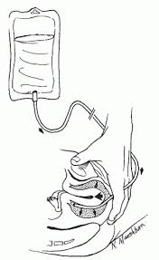 Image result for Uterine Inversion